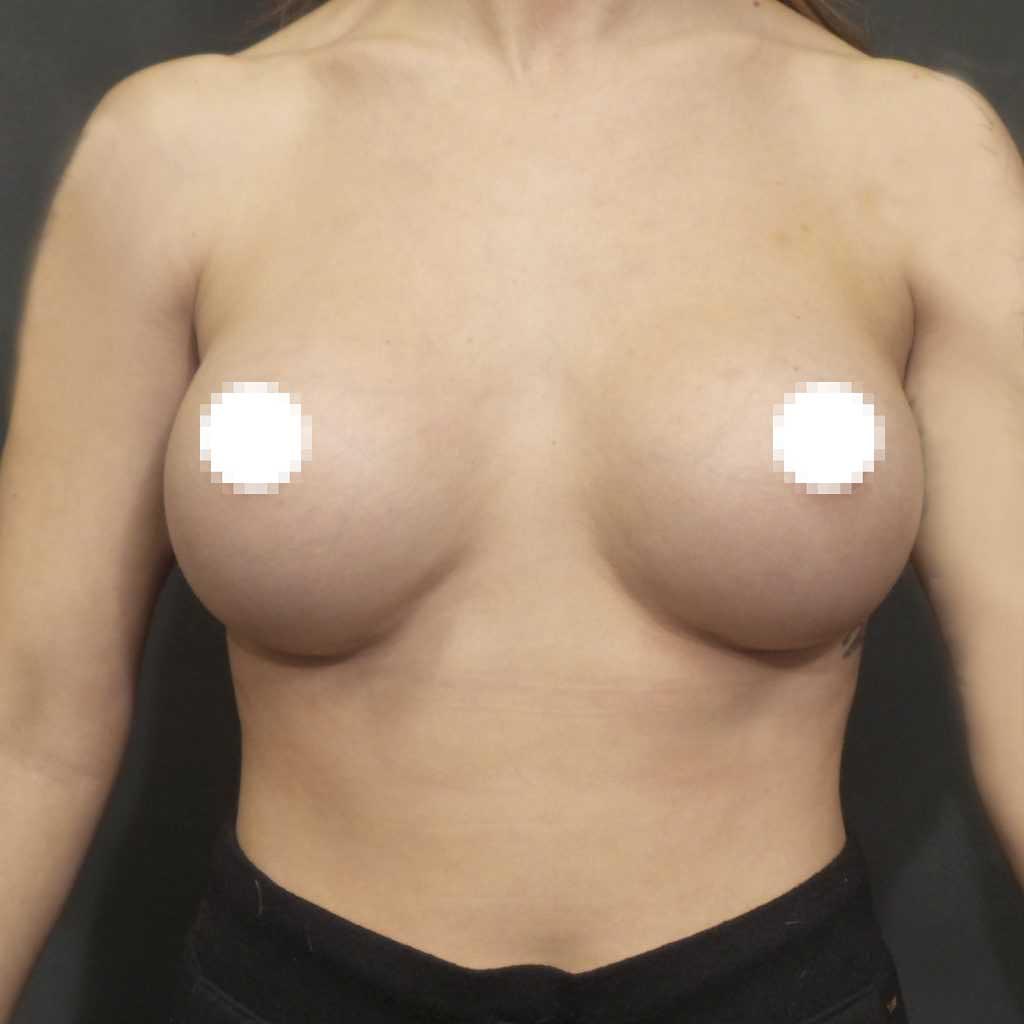 A Before Photo of a Breast Augmentation Plastic Surgery by Dr. Craig Jonov in Seattle and Tacoma