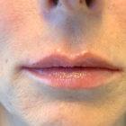 An After Photo of Lip Filler in Seattle and Tacoma