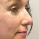 An After Photo of a Rhinoplasty Plastic Surgery by Dr. David Santos in Seattle and Tacoma