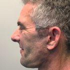 An After Photo of a Male Facelift Plastic Surgery by Dr. David Santos in Seattle and Tacoma
