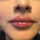 An After Photo of A Restylane Defyne Lip Filler in Seattle and Tacoma