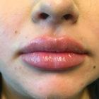 An After Photo of Lip Filler Injections in Seattle and Tacoma