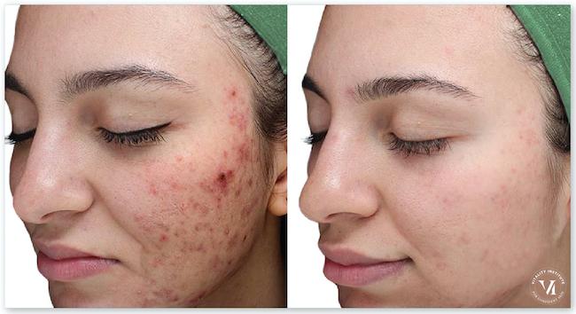 A Before and After Photo of a VI Peel Chemical Peel For Acne