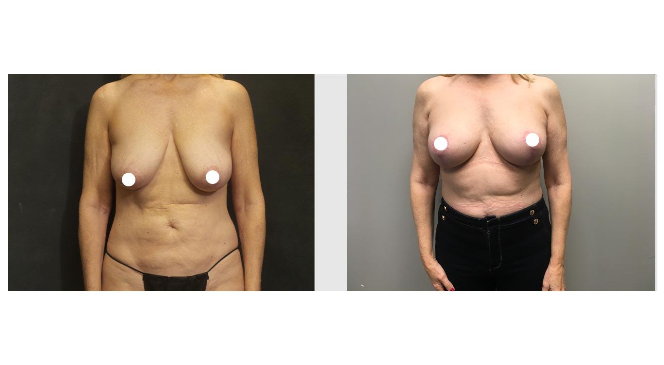 A Before and After Photo of an Auto Augmentation Plastic Surgery by Dr. Craig Jonov in Seattle and Tacoma