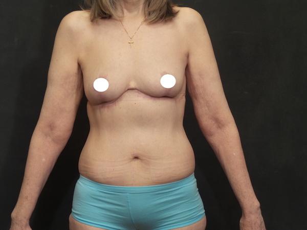 An After Photo of a Reverse Tummy Tuck Plastic Surgery by Dr. Craig Jonov in Seattle and Tacoma