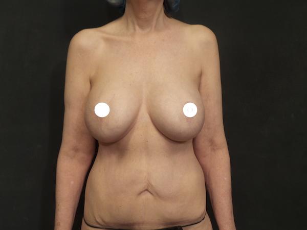 A Before Photo of a Reverse Tummy Tuck Plastic Surgery by Dr. Craig Jonov in Seattle and Tacoma