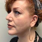 An After Photo of a Facelift Plastic Surgery by Dr. David Santos in Seattle and Tacoma