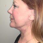 An After Photo of a Neck Lift Plastic Surgery by Dr. David Santos in Seattle and Tacoma