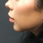 An After Photo of a Chin Augmentation Surgery by Dr. Craig Jonov in Seattle and Tacoma