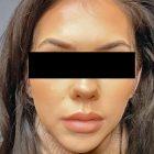An After Photo of Buccal Fat Removal Plastic Surgery by Dr. Craig Jonov in Seattle and Tacoma