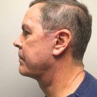 An After Photo of a Male Facelift Plastic Surgery by Dr. David Santos in Seattle and Tacoma