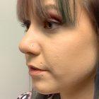 An After Photo of a Rhinoplasty Plastic Surgery by Dr. David Santos in Seattle and Tacoma