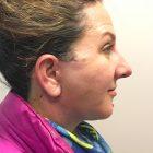 An After Photo of a Facelift Plastic Surgery by Dr. David Santos in Seattle and Tacoma