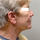 An After Photo of a Facelift Plastic Surgery by Dr. David Santos in Seattle and Tacoma