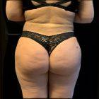 An After Photo of a Brazilian Butt Lift Plastic Surgery by Dr. Craig Jonov in Seattle and Tacoma