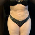 An After Photo of a Liposuction Plastic Surgery by Dr. Craig Jonov in Seattle and Tacoma