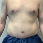 An After Photo of a Male Tummy Tuck by Dr. Craig Jonov in Seattle and Tacoma