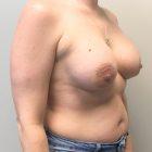 An After Photo of a Breast Augmentation Plastic Surgery by Dr. Craig Jonov in Seattle and Tacoma