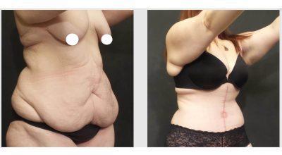 A Before And After Photo Of A Fleur De Lis Tummy Tuck Plastic Surgery by Dr. Craig Jonov in Seattle and Tacoma