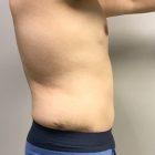 An After Photo of a Male Tummy Tuck Plastic Surgery by Dr. Craig Jonov in Seattle and Tacoma