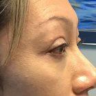 An After Photo of a Blepharoplasty Plastic Surgery by Dr. David Santos in Seattle and Tacoma