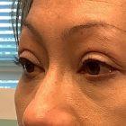 An After Photo of a Blepharoplasty Plastic Surgery by Dr. David Santos in Seattle and Tacoma