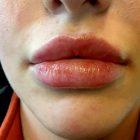 An After Photo of Restylane Defyne Lip Filler in Seattle and Tacoma