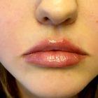 An After Photo of Juvederm Lip Filler In Seattle and Tacoma
