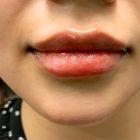 An After Photo of Restylane Defyne Lip and Chin Filler in Seattle and Tacoma