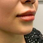 An After Photo of Restylane Defyne Lip and Chin Filler in Seattle and Tacoma