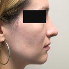 An After Photo of a Rhinoplasty Plastic Surgery by Dr. Craig Jonov in Seattle and Tacoma