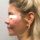 An After Photo of a Mini Facelift Plastic Surgery by Dr. David Santos in Seattle and Tacoma