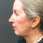 An After Photo of A Swiftlift Facelift Plastic Surgery by Dr. Craig Jonov in Seattle and Tacoma