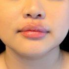 An After Photo of Restylane L Lip Filler in Seattle and Tacoma