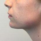 An After Photo of Chin Filler In Seattle and Tacoma