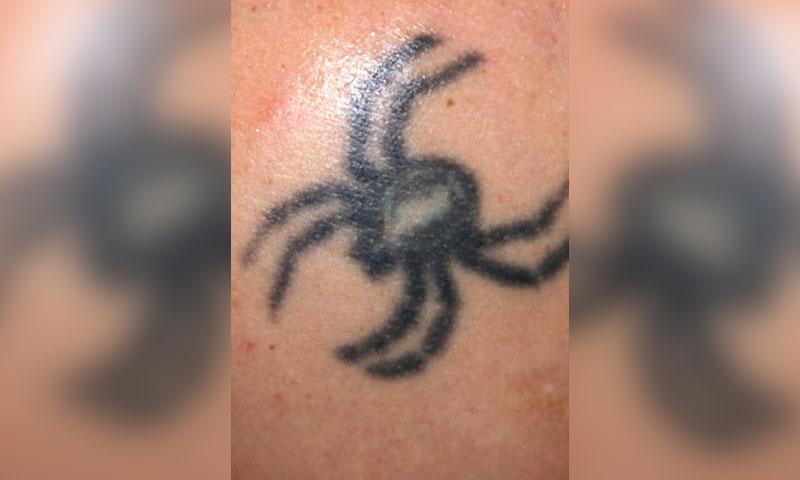 Laser Tattoo Removal in Kennewick  TriCities Synergy MedAesthetics