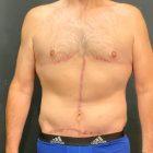 An After Photo of a Fleur de Lis Tummy Tuck by Dr. Craig Jonov in Seattle and Tacoma