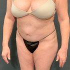 An After Photo of a Tummy Tuck Plastic Surgery by Dr. Craig Jonov in Seattle and Tacoma