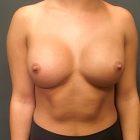 An After Photo of a Breast Augmentation Plastic Surgery by Dr. Craig Jonov in Seattle and Tacoma