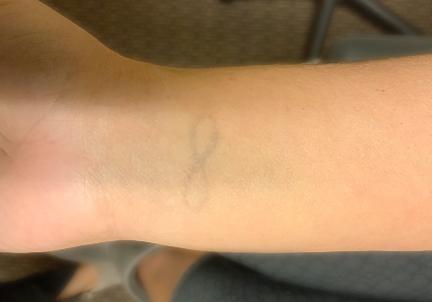 An After Photo of a Laser Tattoo Removal in Seattle and Tacoma