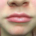 An After Photo of Restylane Defyne Lip Filler in Seattle and Tacoma