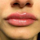 An After Photo of Juvederm Lip Filler In Bellevue and Kirkland