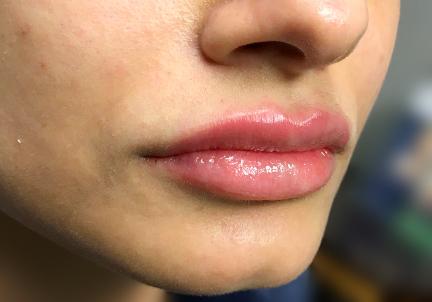 An After Photo of Juvederm Lip Filler In Bellevue and Kirkland