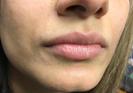 A Before Photo of Juvederm Lip Filler In Bellevue and Kirkland