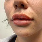 An After Photo of Restylane Defyne Lip Filler In Seattle and Tacoma