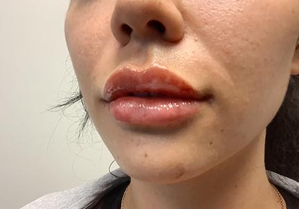 An After Photo of Restylane Defyne Lip Filler In Seattle and Tacoma