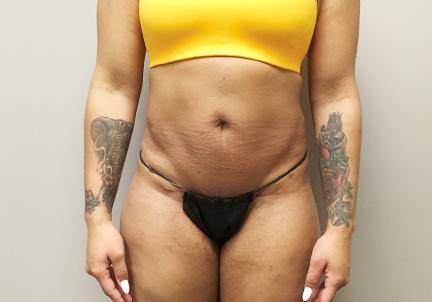 An After Photo of Liposuction Plastic Surgery by Dr. Craig Jonov in Seattle and Tacoma