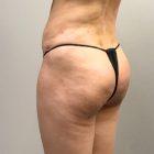 An After Photo of a Brazilian Butt Lift Plastic Surgery by Dr. Craig Jonov in Seattle and Tacoma