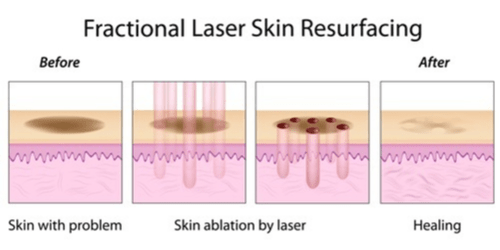 A Graphic Showing How Fractional Laser Skin Resurfacing Works