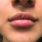 An After Photo of Restylane Defyne Lip Filler In Seattle and Tacoma